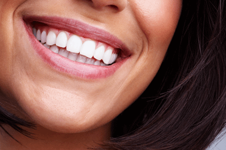 Groupon - € 49 Voor Een Bright
White Smiles Thuisbleek Set Van Almere Dental Bv (Waarde € 149)